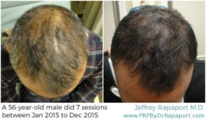 Eclipse PRP San Antonio | Hair Restoration | Hair Loss