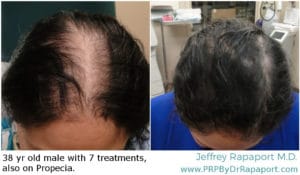 Eclipse PRP San Antonio | Hair Restoration Before and After | Hair Loss