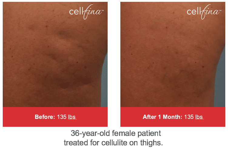 Cellfina Before and After bucay center for dermatology