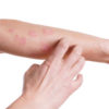 Rash Treatment San Antonio TX
