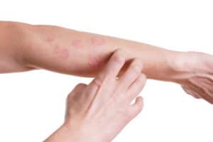 Rash Treatment San Antonio TX