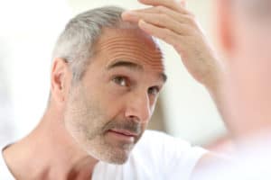 Alopecia Areata San Antonio TX | Hair Loss