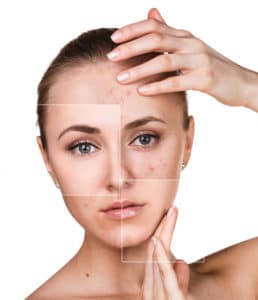 Acne Cure San Antonio, TX