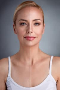 Ultherapy Treatment San Antonio TX