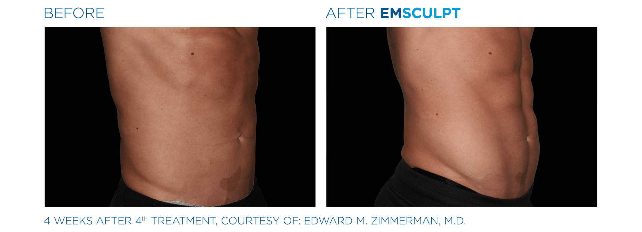 Emsculpt Before and After