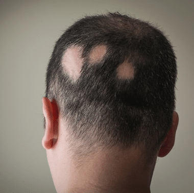 Alopecia San Antonio TX