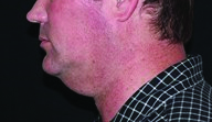 Kybella before treatment on male patient