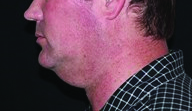 Kybella Before And After Kybella Before And After