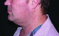 Kybella Before And After Kybella Before And After