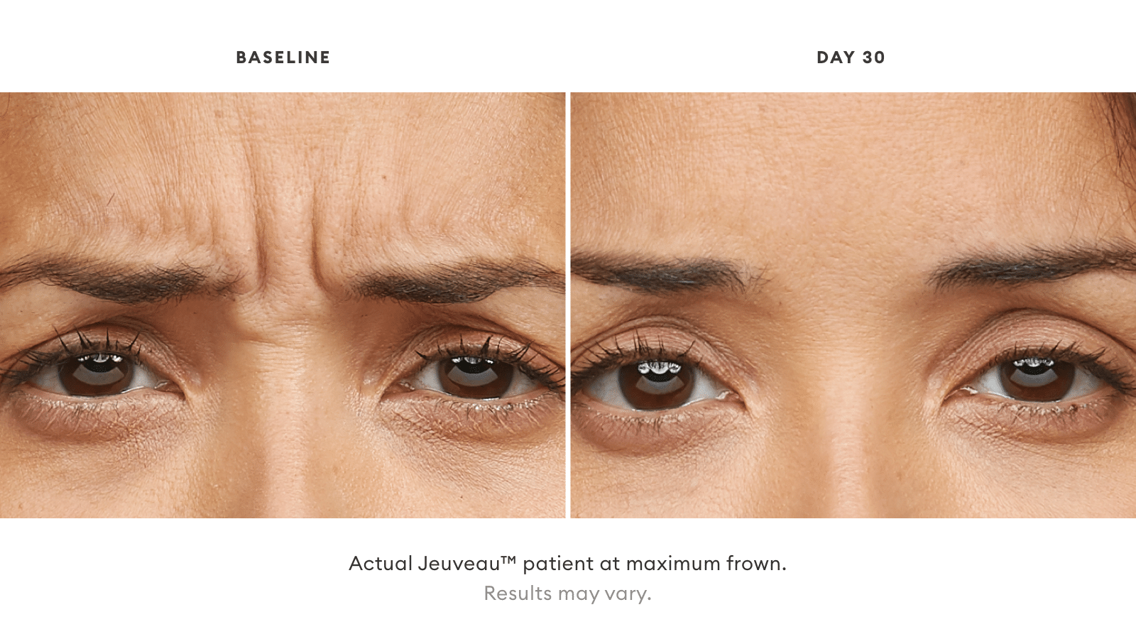 Jeuveau™ San Antonio TX | Jeuveau™ Injections Sonterra | Bucay Center Jeuveau™ San Antonio TX | Jeuveau™ Injections Sonterra | Bucay Center