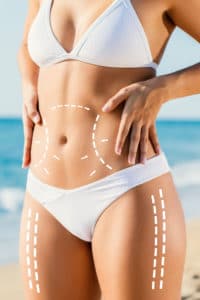 Close up detail of slim attractive female torso in white bikini outdoors.Conceptual dotted surgical incision lines marked on skin for tummy tuck.Girl touching hips with hands.Image is not body shape retouched.
