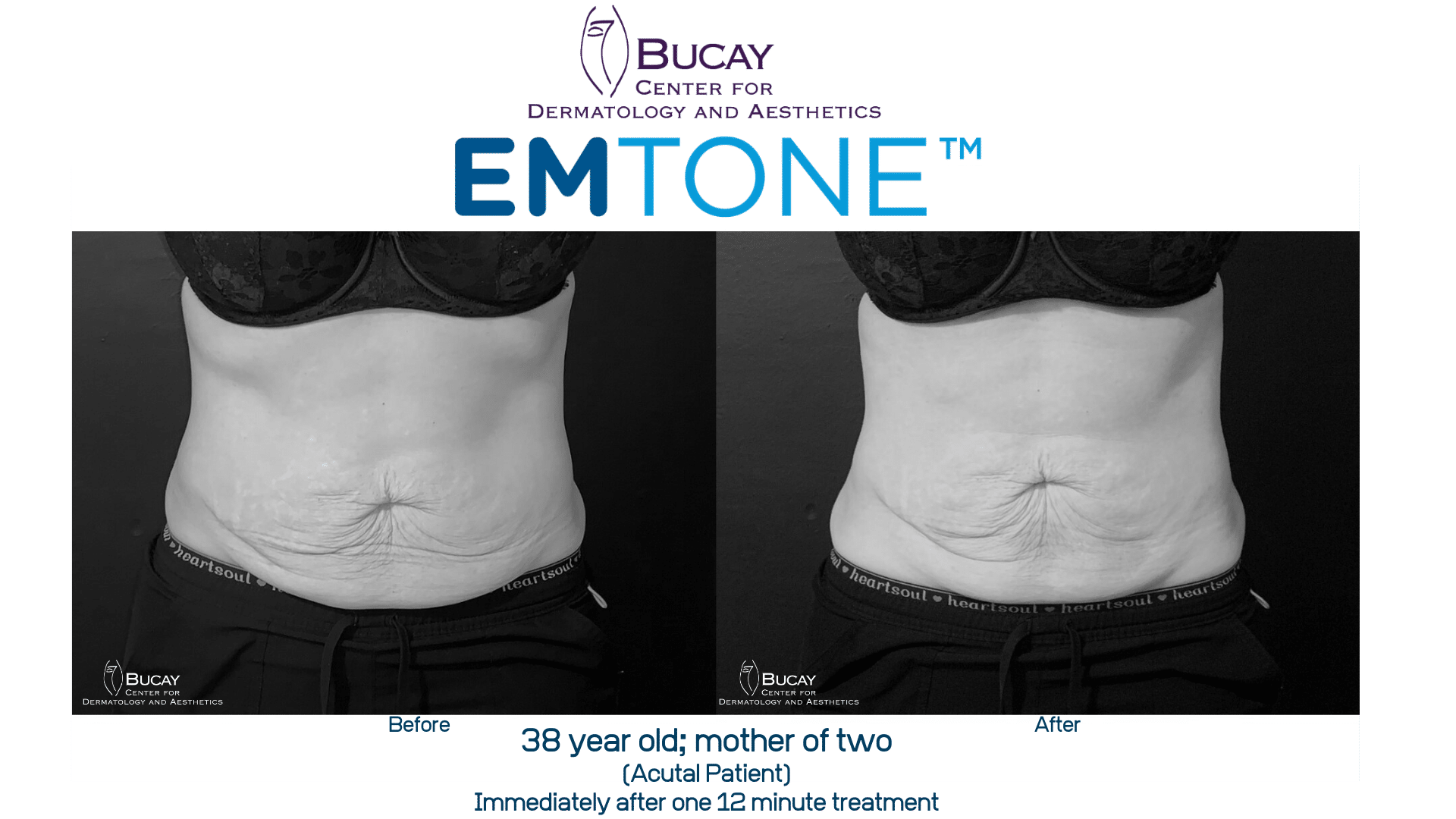 A before and after image set of a woman who recieved Emtone treatment on her abdomen