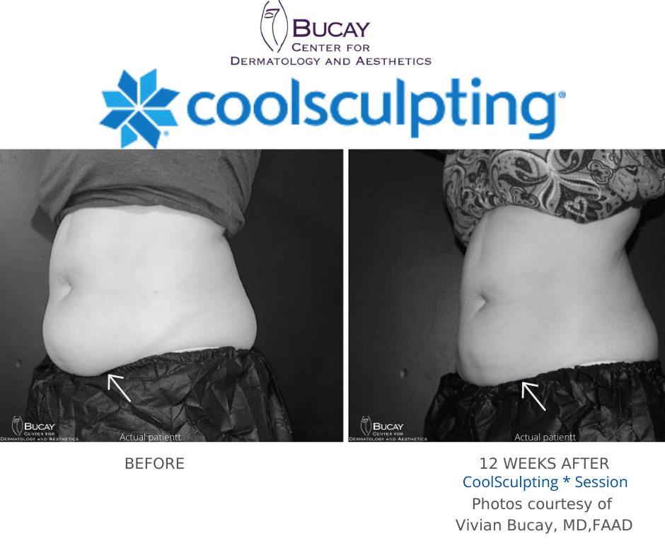 Coolsculpting Elite before and after bucay center for dermatology