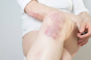 Large red, inflamed, flaky rash on the knees knees and elbow