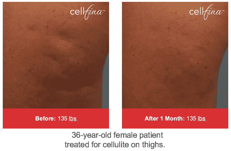 Cellfina Treatment Before and After San Antonio TX