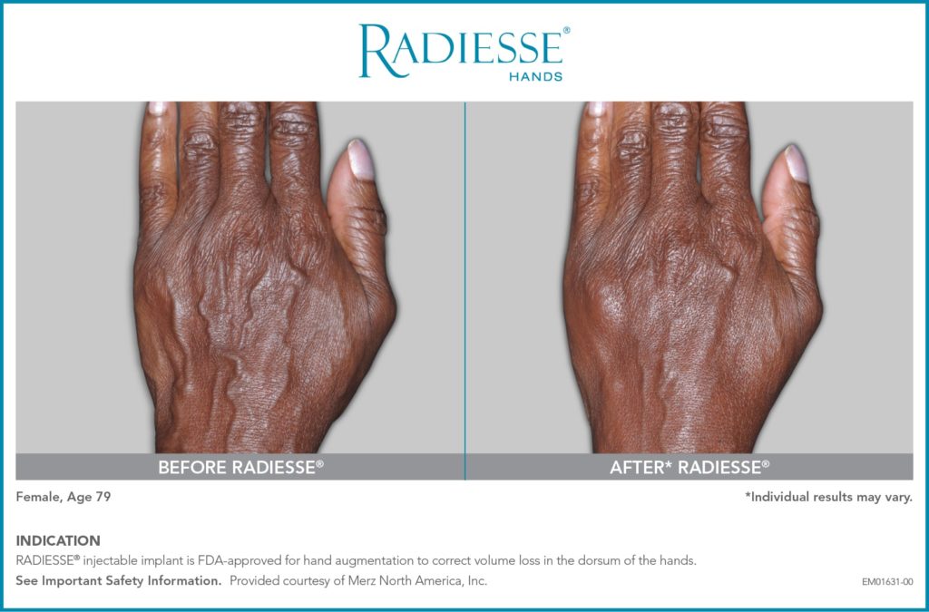 EM01631 00 RADIESSE Hands CON BA1 1