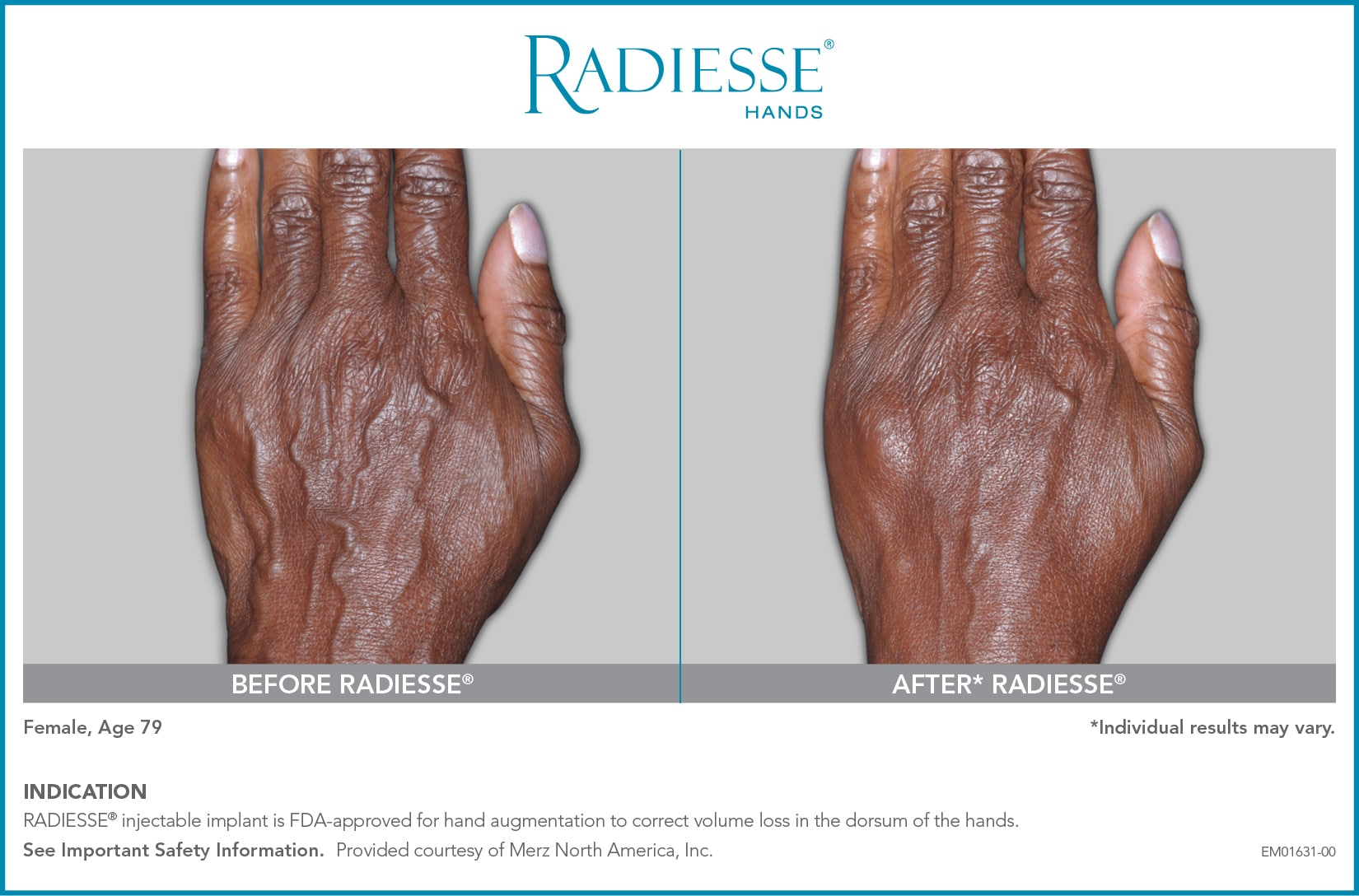 EM01631 00 RADIESSE Hands CON BA1 1