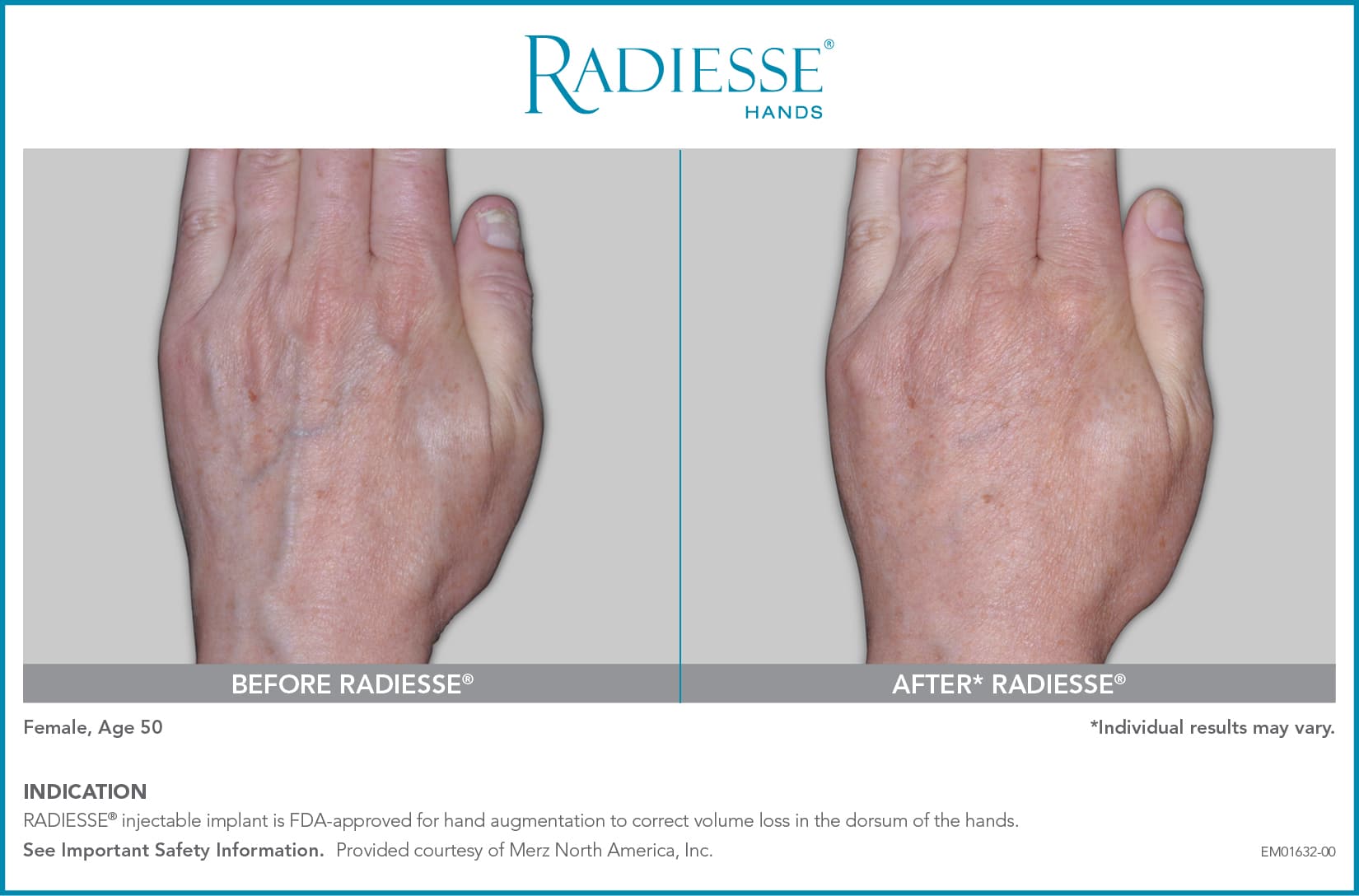 EM01632 00 RADIESSE Hands CON BA2 1