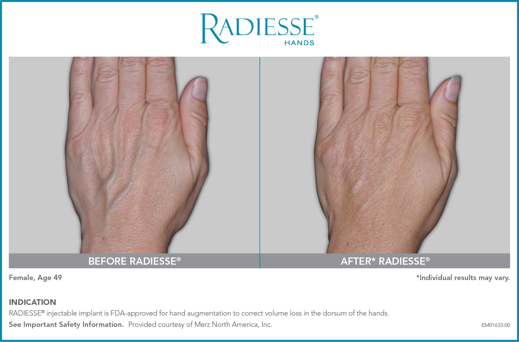 EM01633 00 RADIESSE Hands CON BA3 1