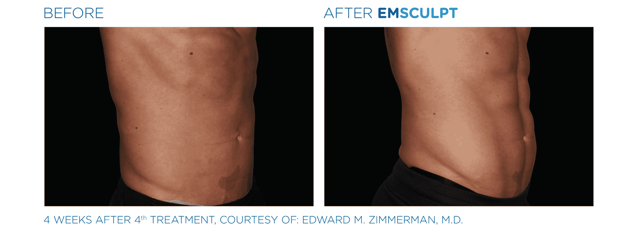 FAQ: EMSCULPT® - San Antonio & Boerne Dermatologist