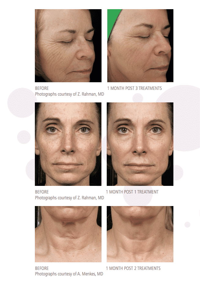 middle-aged woman before and after Fraxel facial rejuvenation, fewer lines and crow’s feet after treatment