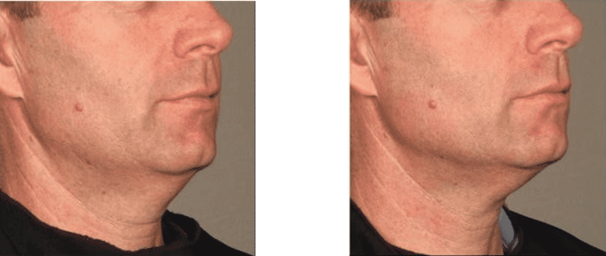 before and after Ultherapy for skin tightening and firming