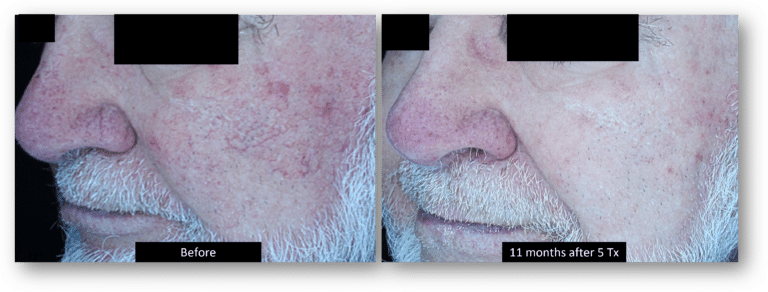 DermaV B&A (4)