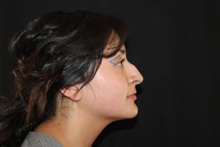 Before Image: Non-Surgical Rhinoplasty - right-side