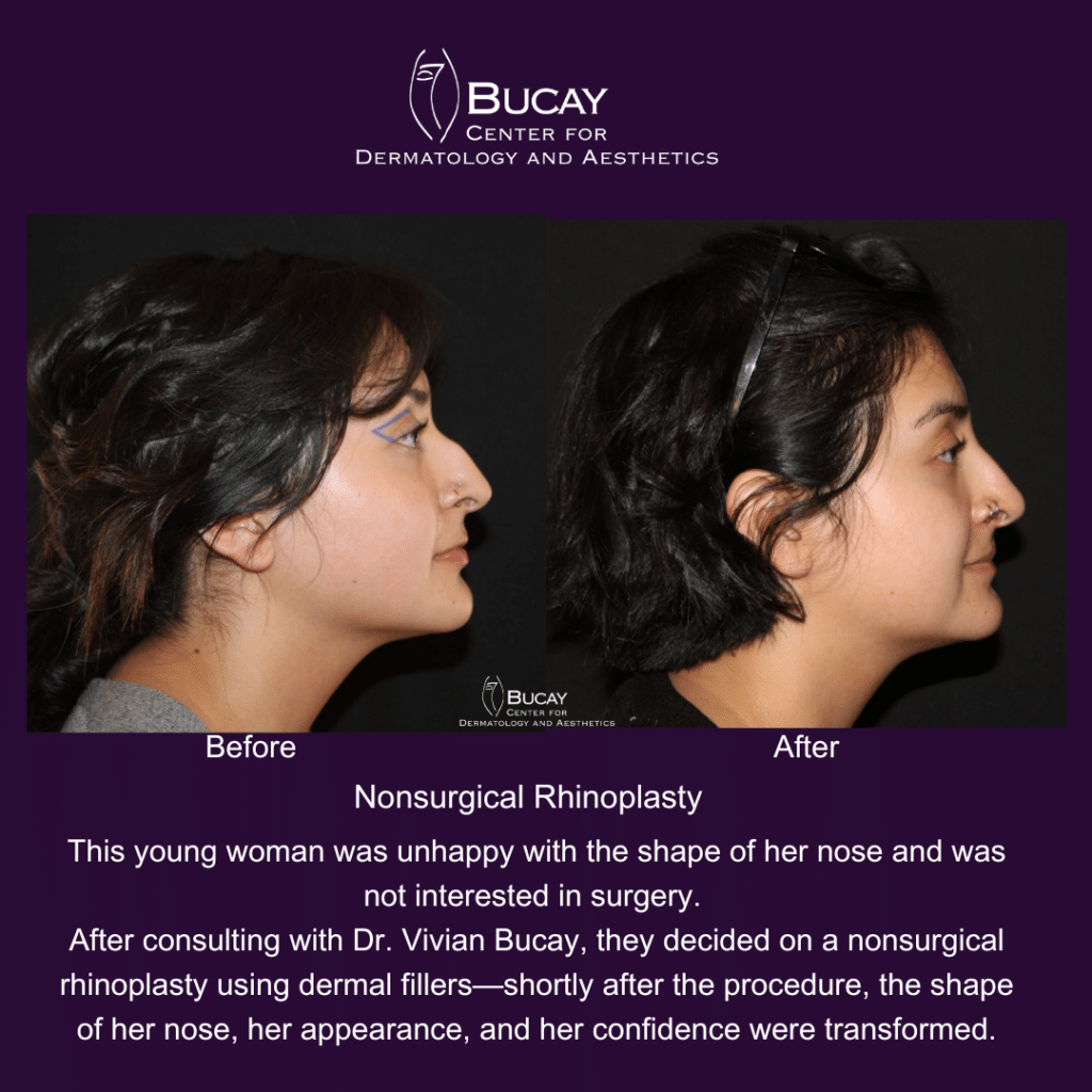 Before & After Non-Surgical Rhinoplasty