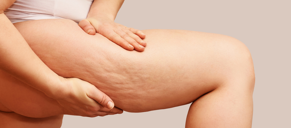 Woman pinching skin on leg to show cellulite dimples
