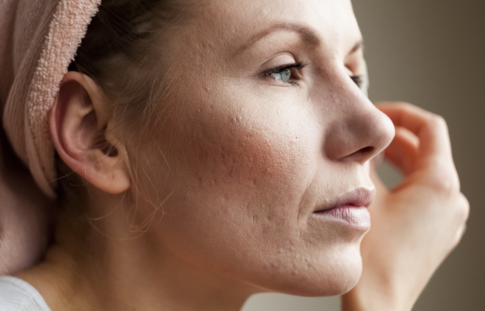 Woman with acne scarring on her cheeks