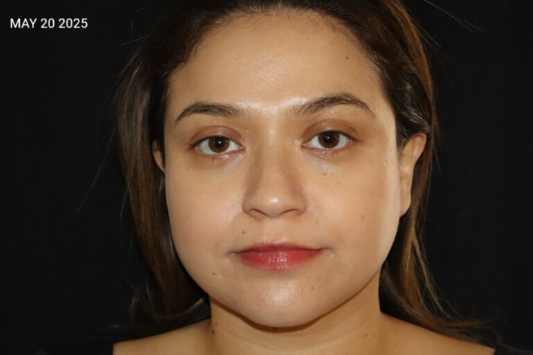 After Image: Acne Journey - front