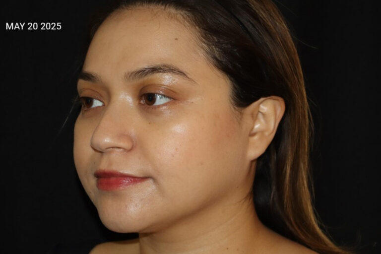 After Image: Acne Journey - left-front-oblique