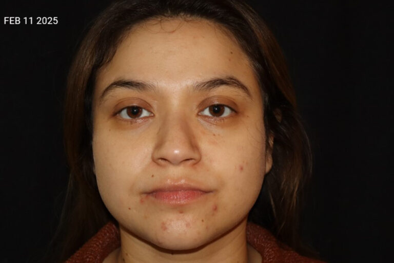 Before Image: Acne Journey - front