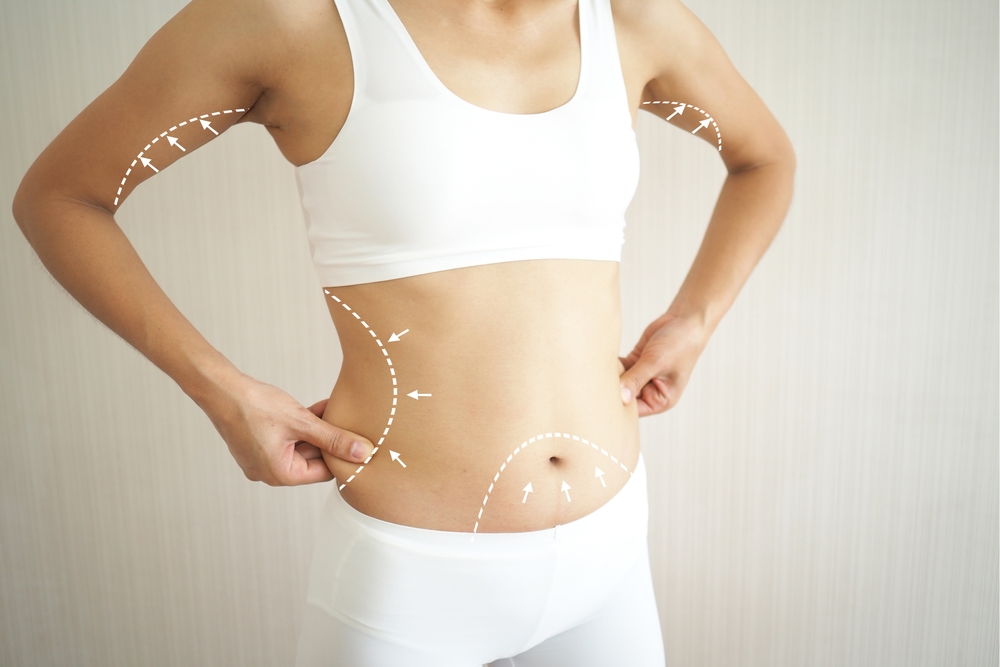 Woman in fitness wear pinching abdominal fat with contour lines illustrating nonsurgical fat reduction treatment areas