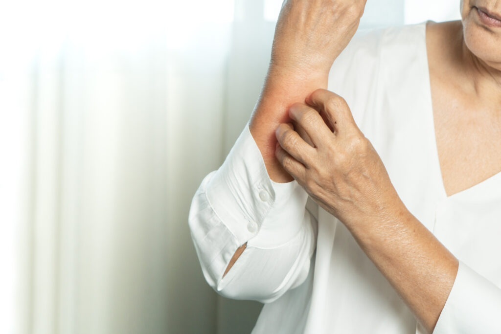 Woman scratching eczema flareup on her forearm while wearing a constricting blouse